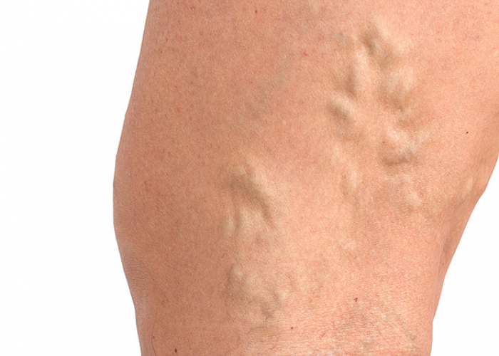 Ulcerul picioarelor venoase – Prevenire, Sosete de compresie pierdere în greutate